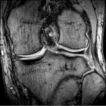 Knee MR scan