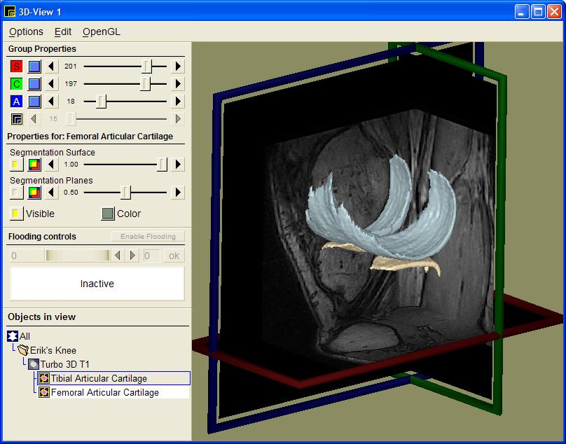 Knee Cartilage 3D